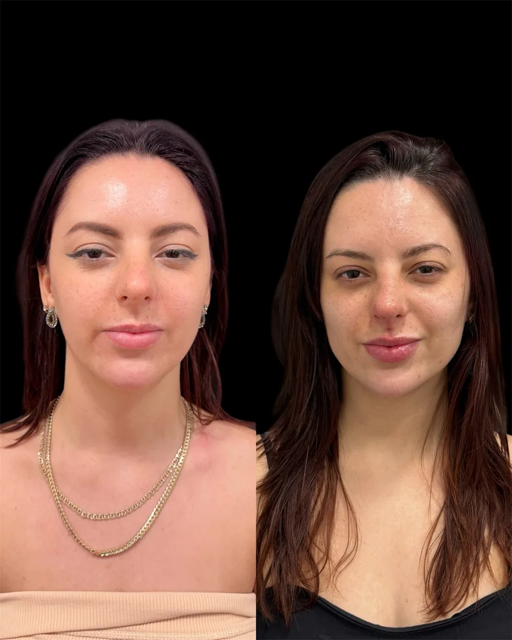 Resultado Harmonização facial · 4ml — Da Vinci Aesthetic