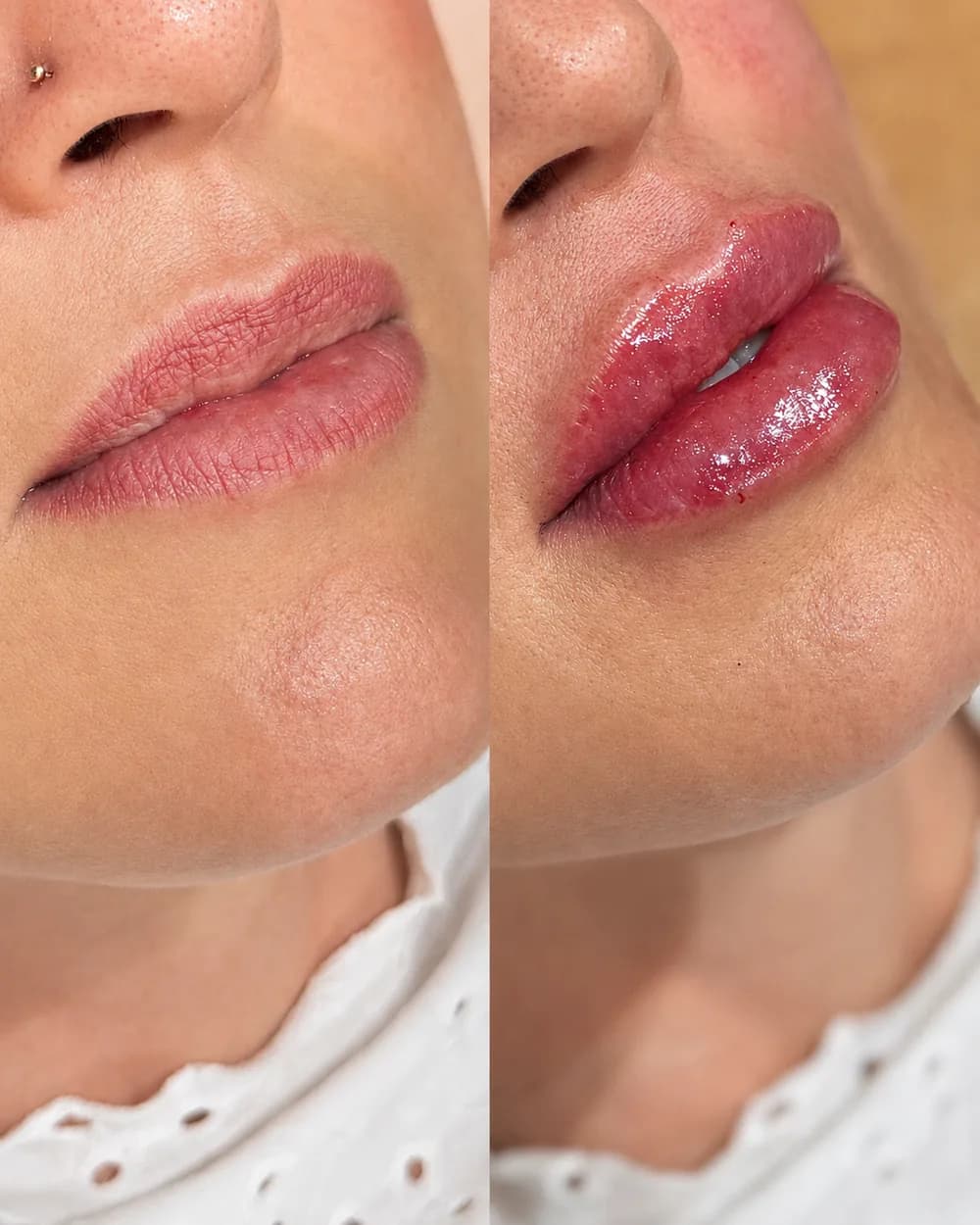 Resultado Preenchimento labial — Da Vinci Aesthetic