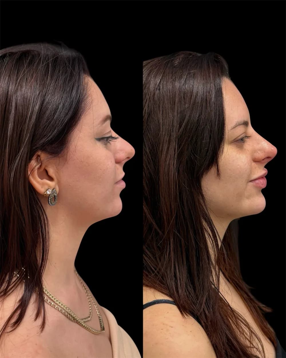 Resultado Harmonização facial — Da Vinci Aesthetic