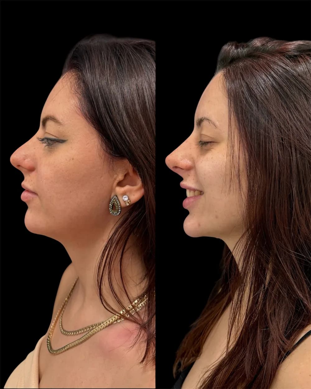 Resultado Harmonização facial — Da Vinci Aesthetic