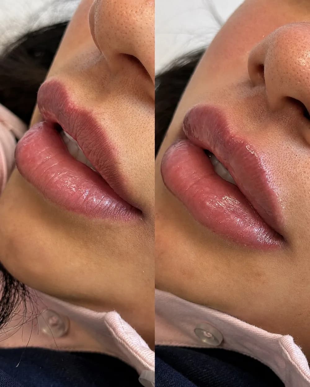 Resultado Preenchimento labial — Da Vinci Aesthetic