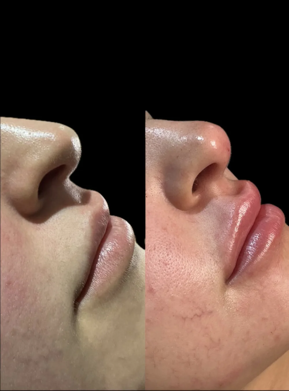 Resultado Preenchimento labial — Da Vinci Aesthetic
