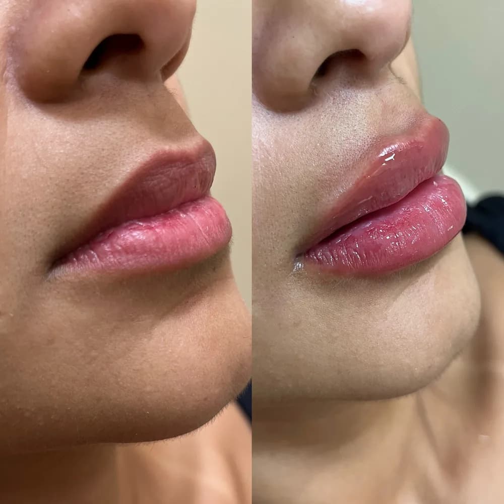 Resultado Preenchimento labial — Da Vinci Aesthetic