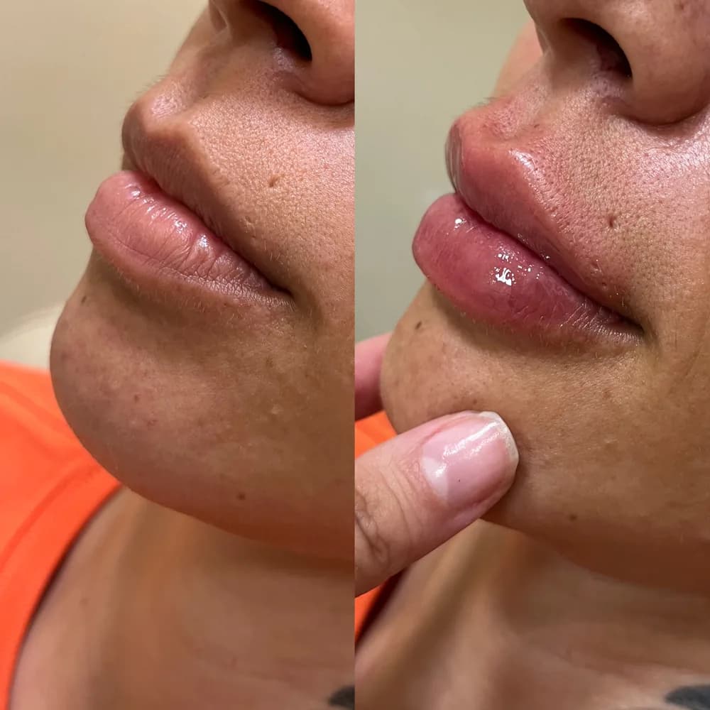 Resultado Preenchimento labial — Da Vinci Aesthetic