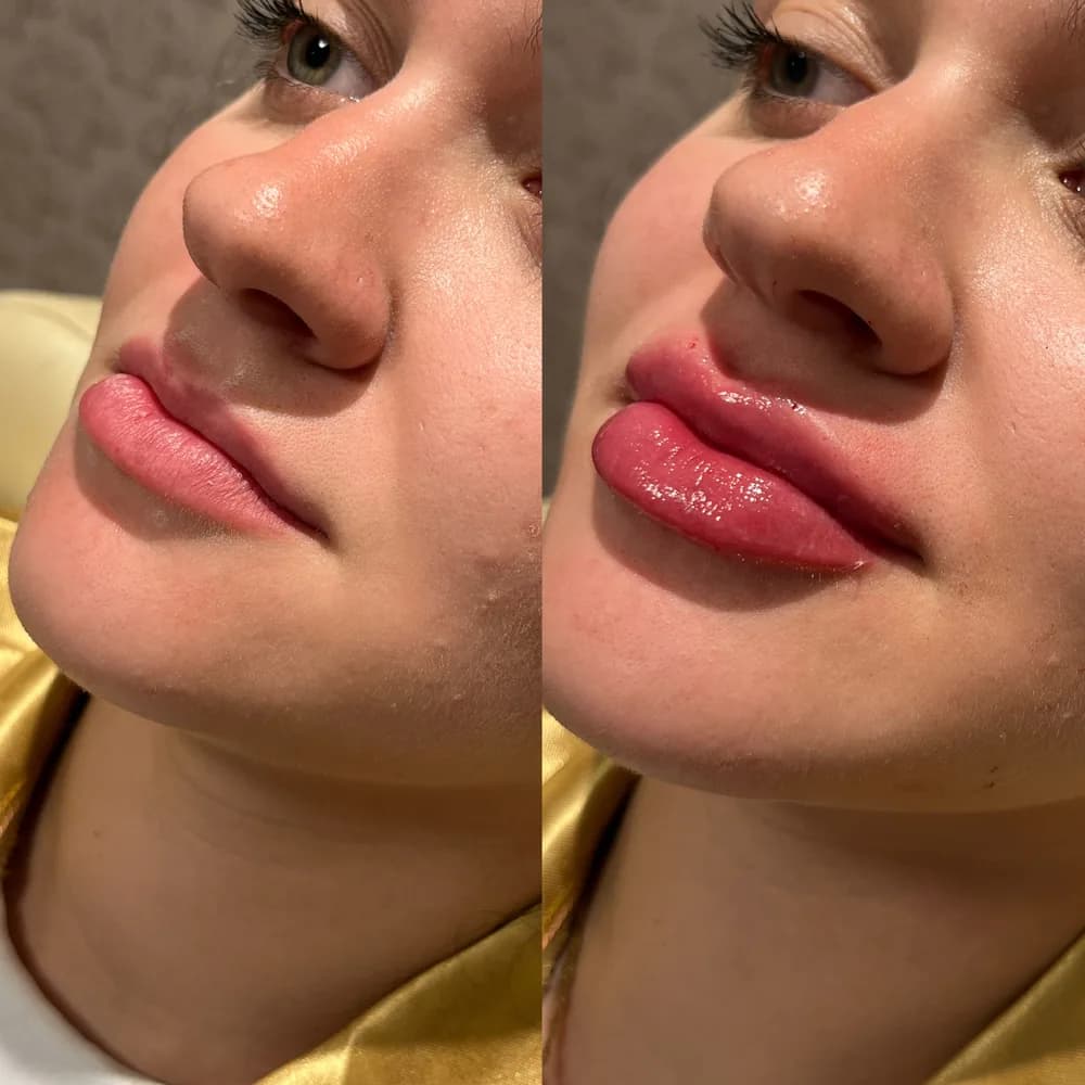 Resultado Preenchimento labial — Da Vinci Aesthetic
