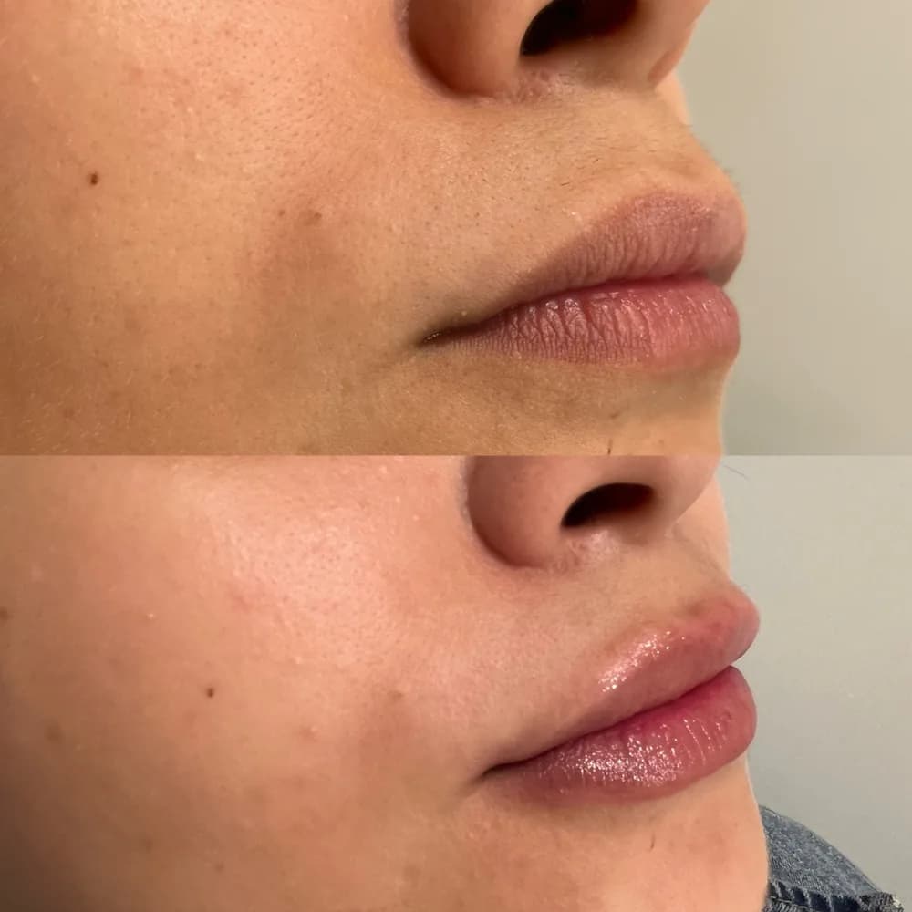 Resultado Preenchimento labial — Da Vinci Aesthetic