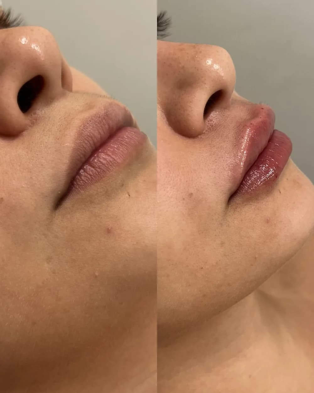 Resultado Preenchimento labial — Da Vinci Aesthetic