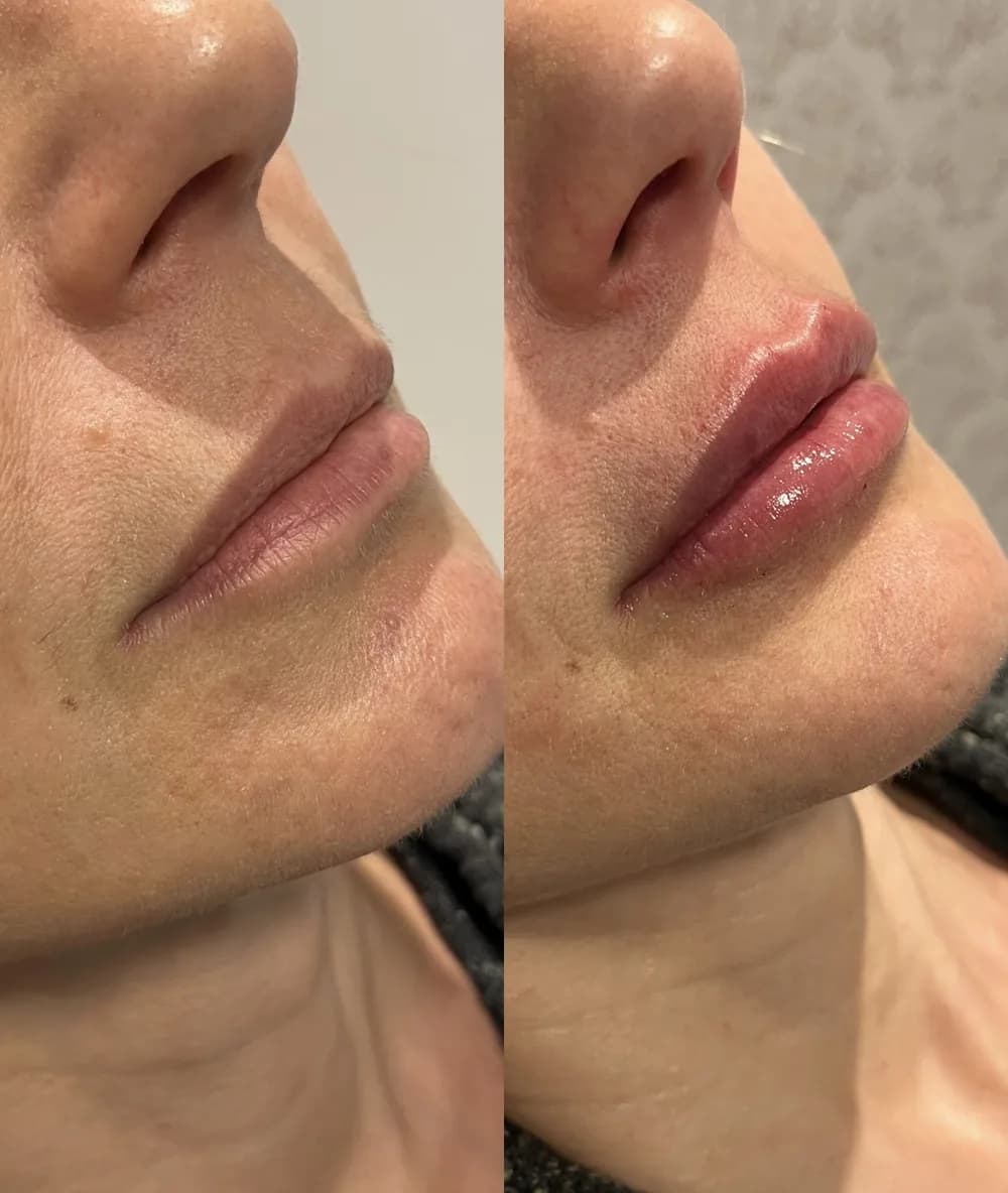 Resultado Preenchimento labial — Da Vinci Aesthetic