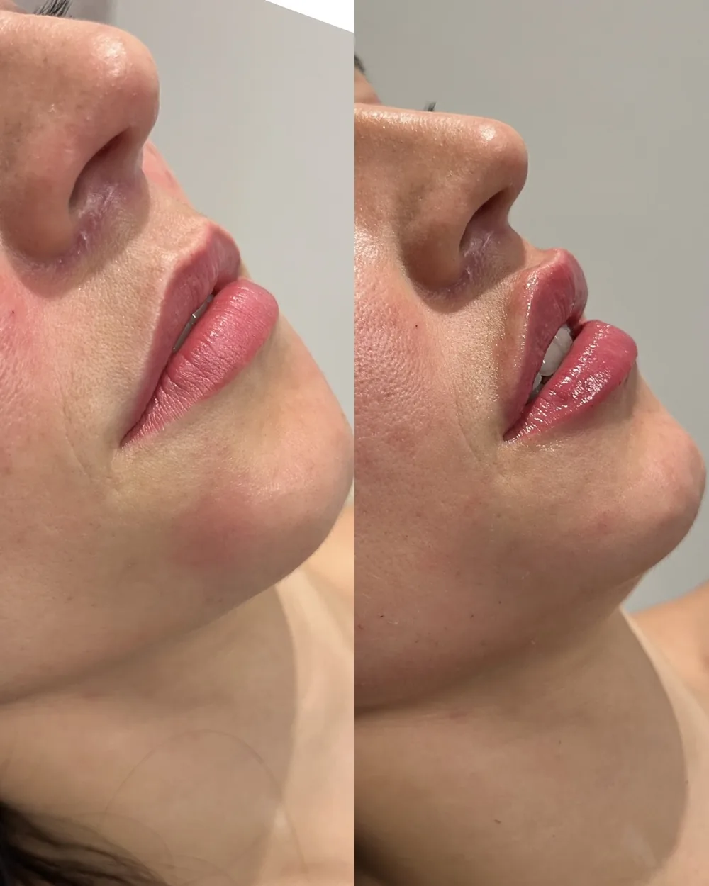 Resultado Preenchimento labial — Da Vinci Aesthetic