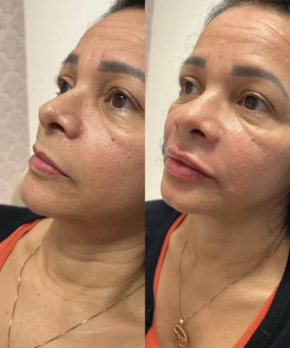 Resultado Preenchimento labial — Da Vinci Aesthetic