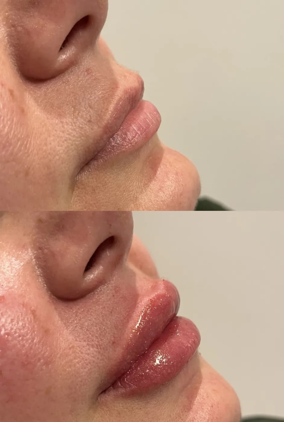 Resultado Preenchimento labial — Da Vinci Aesthetic