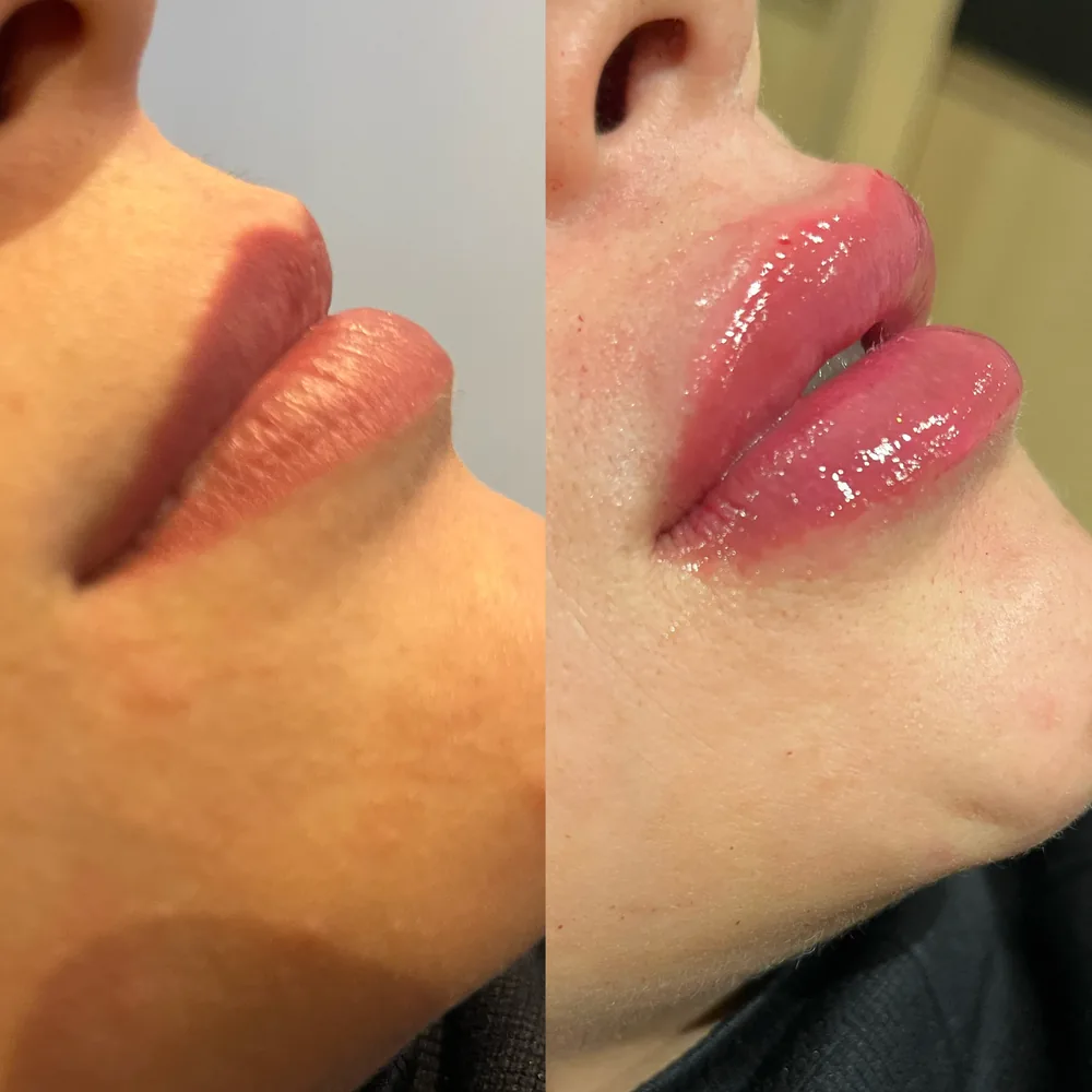 Resultado Preenchimento labial — Da Vinci Aesthetic