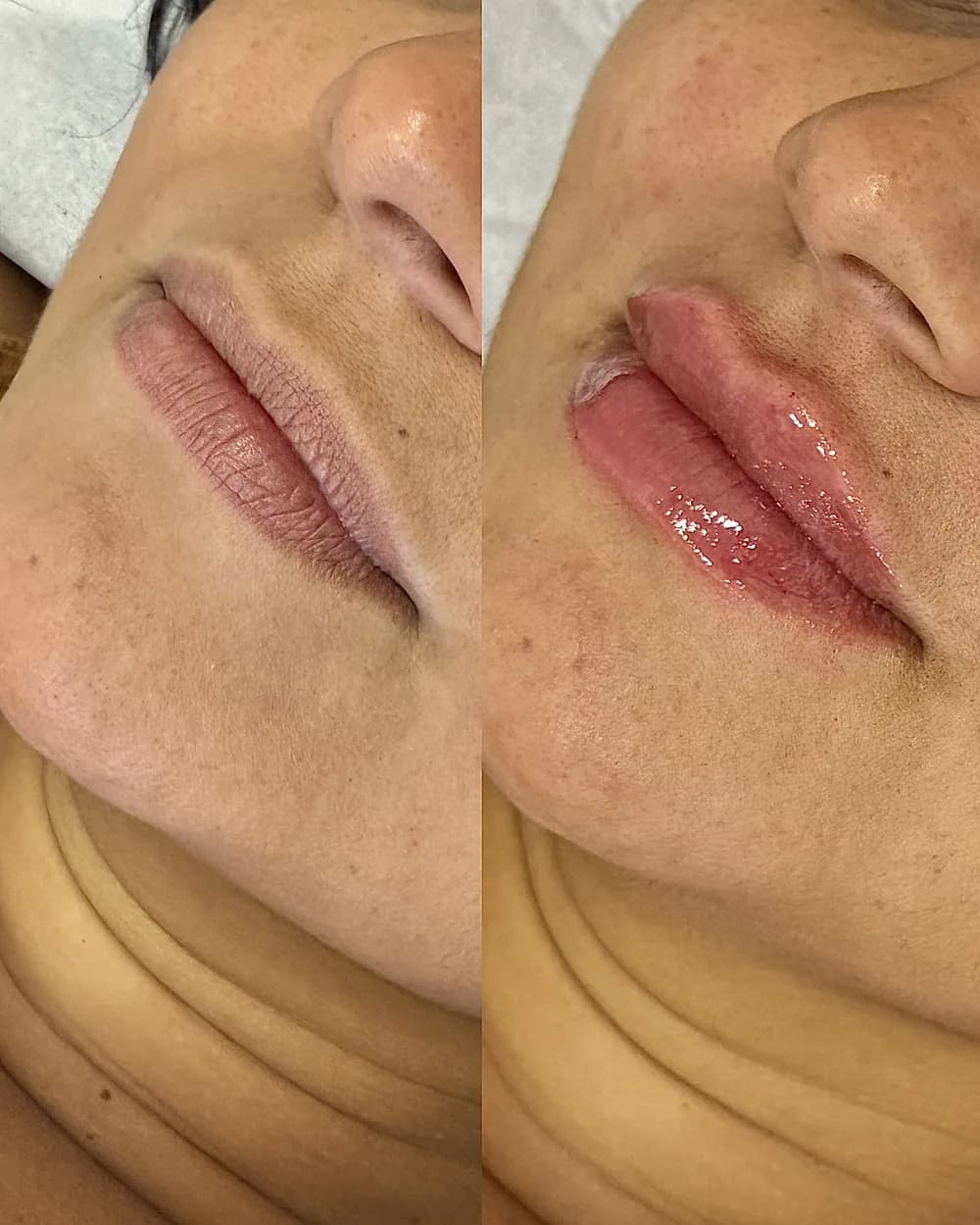 Resultado Preenchimento labial — Da Vinci Aesthetic