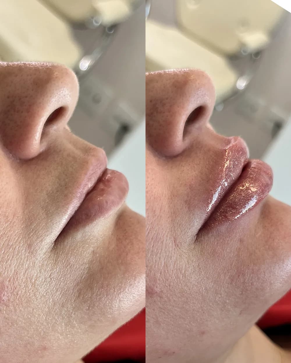 Resultado Preenchimento labial — Da Vinci Aesthetic