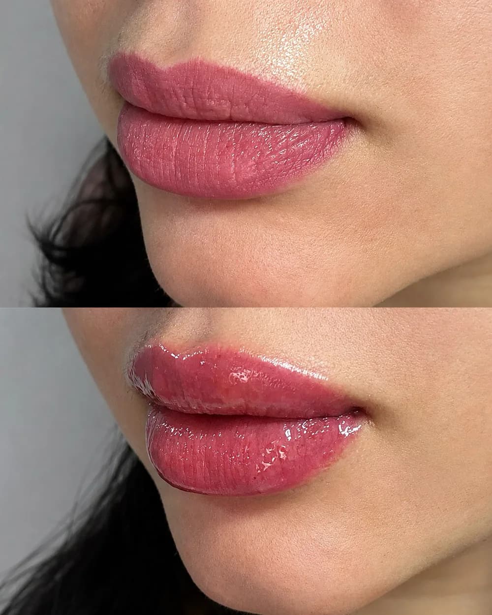 Resultado Preenchimento labial — Da Vinci Aesthetic