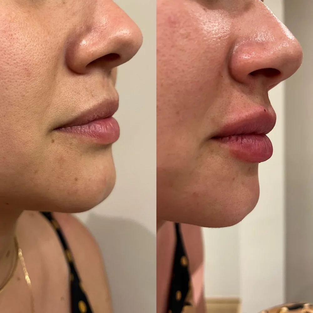 Resultado Preenchimento labial — Da Vinci Aesthetic