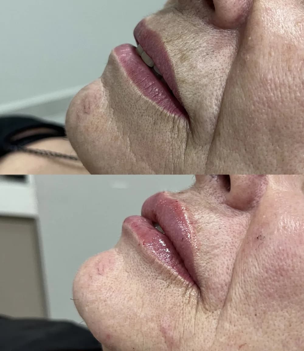 Resultado Preenchimento labial — Da Vinci Aesthetic