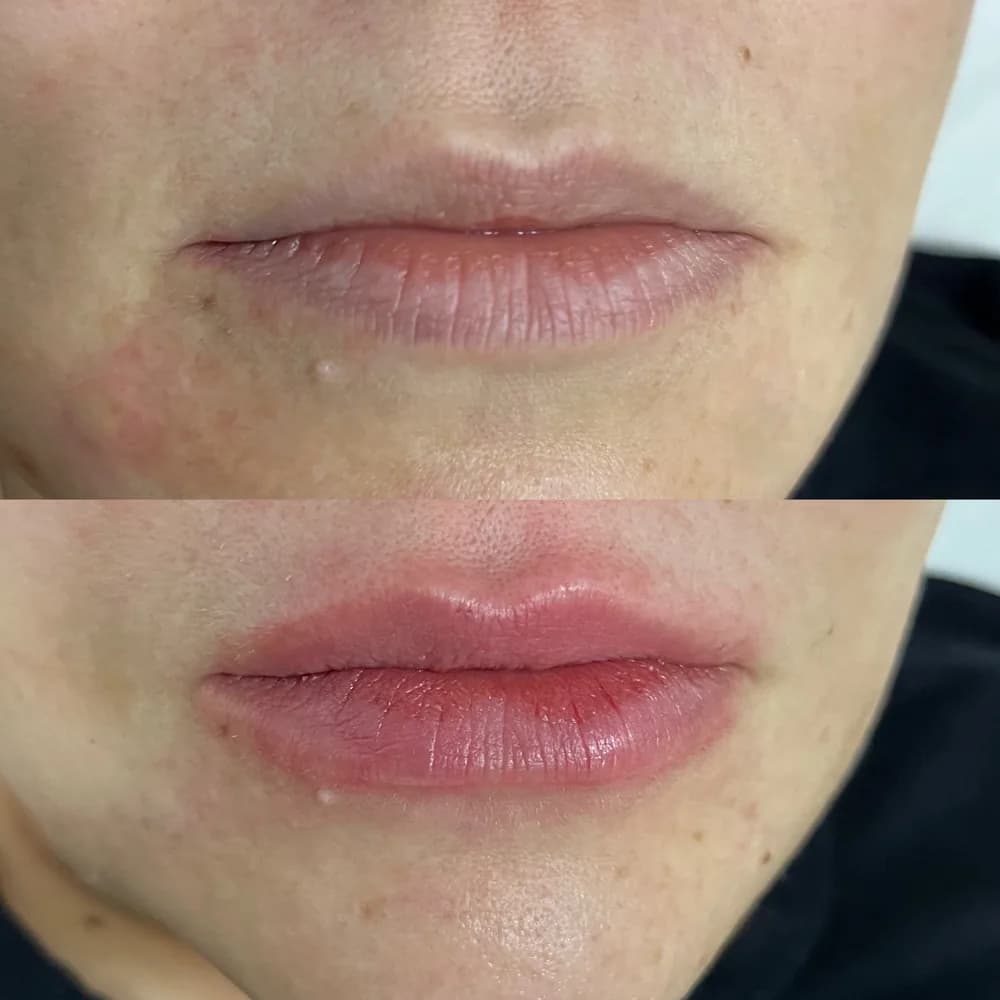 Resultado Preenchimento labial — Da Vinci Aesthetic