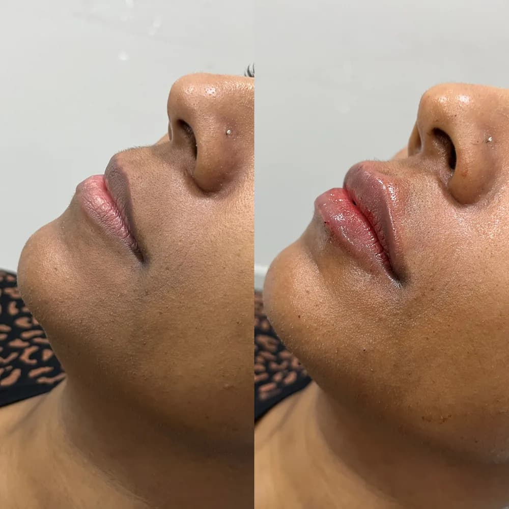 Resultado Preenchimento labial — Da Vinci Aesthetic