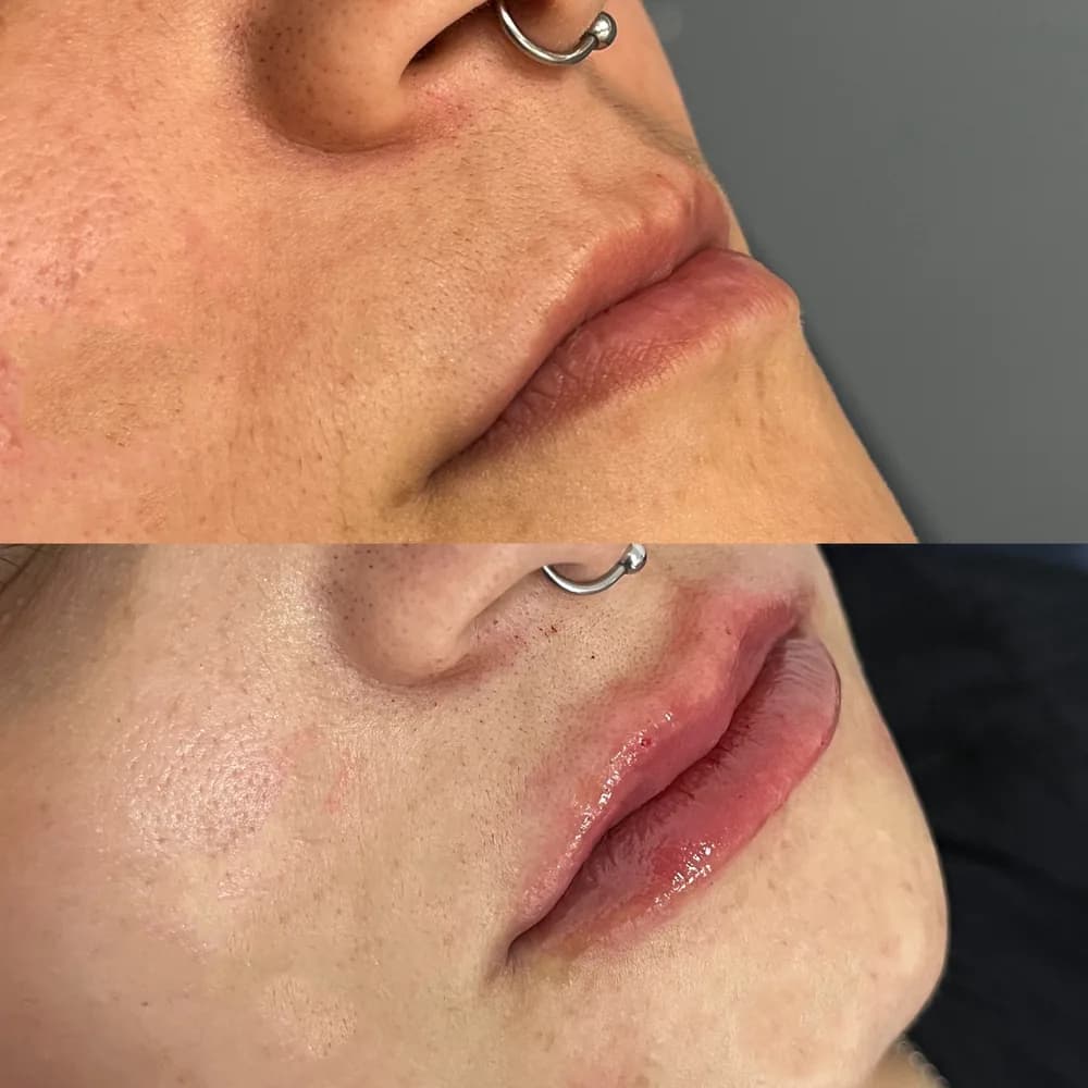 Resultado Preenchimento labial — Da Vinci Aesthetic
