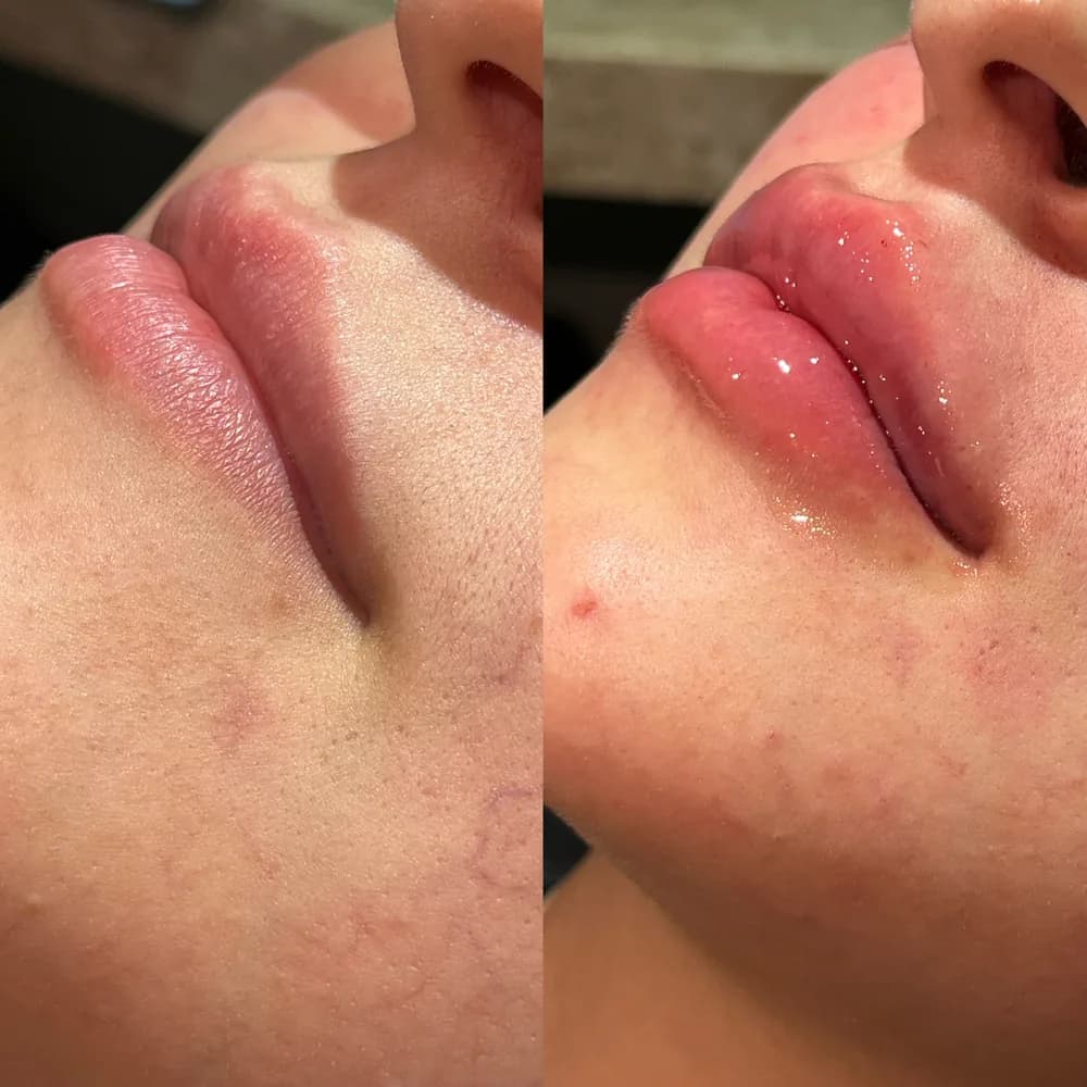 Resultado Preenchimento labial — Da Vinci Aesthetic