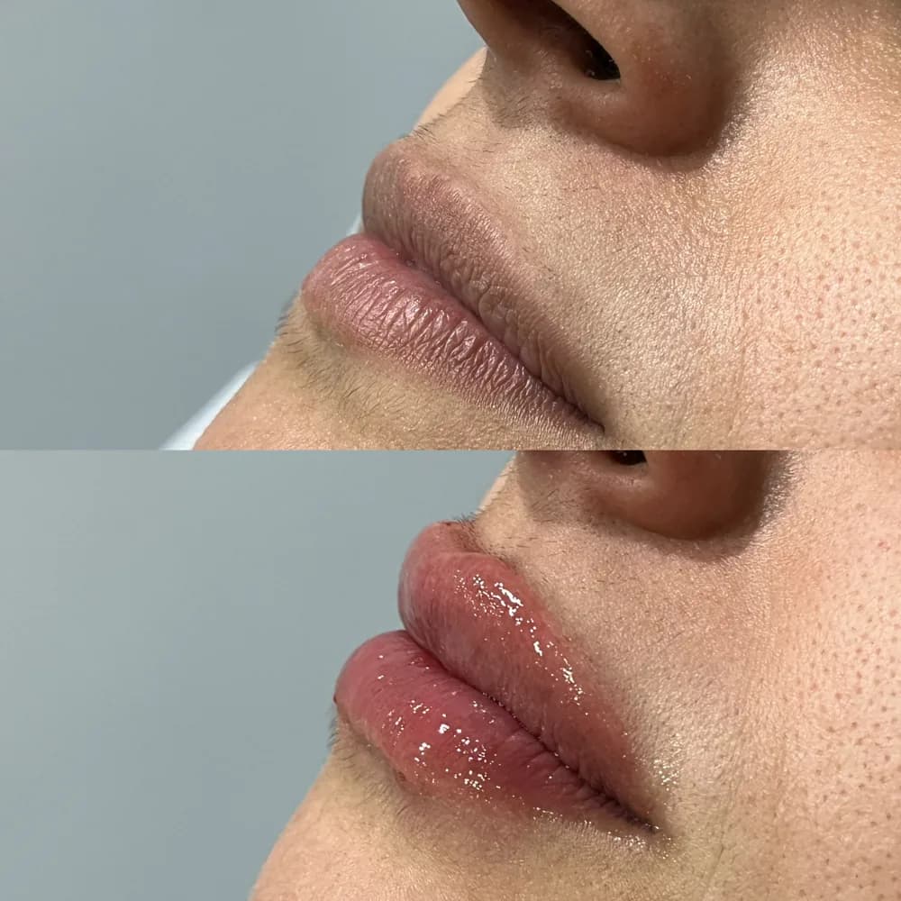 Resultado Preenchimento labial — Da Vinci Aesthetic