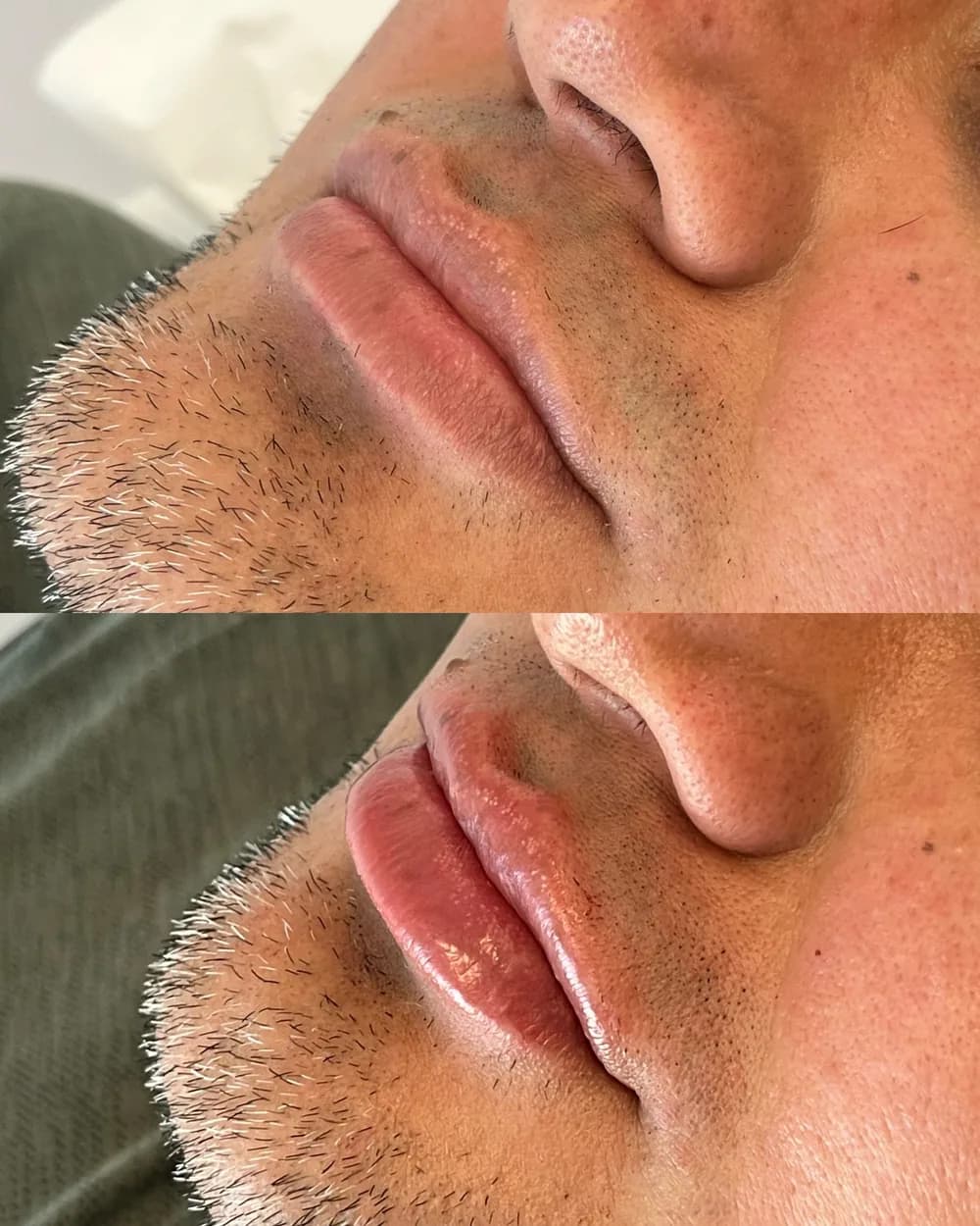 Resultado Preenchimento labial — Da Vinci Aesthetic