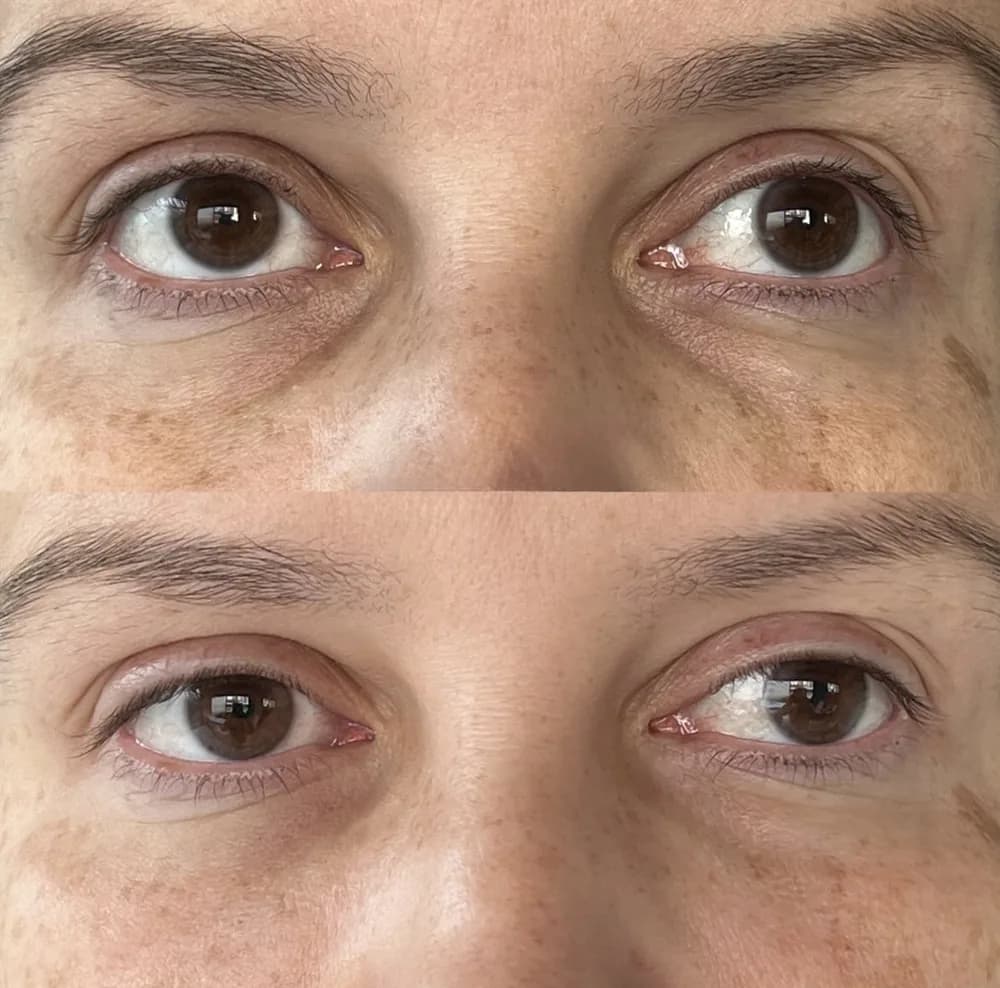 Resultado Preenchimento de olheira — Da Vinci Aesthetic